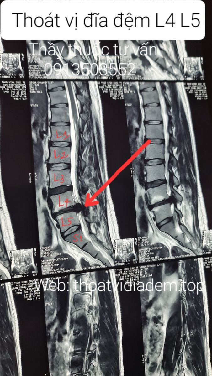 Chữa thoát vị đĩa đệm L4 L5